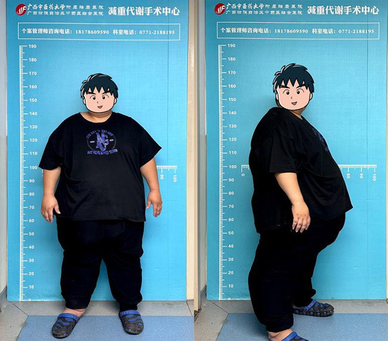 2术前胖友身体正侧站位.jpg 2术前胖友身体正侧站位.jpg