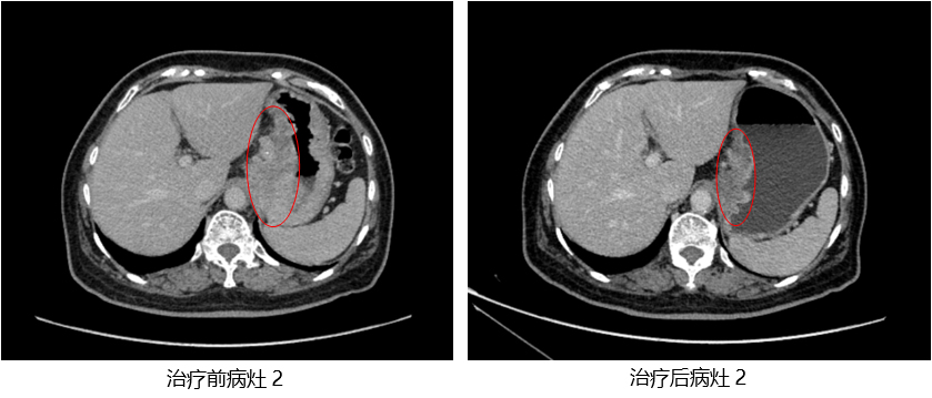 病灶2.jpg