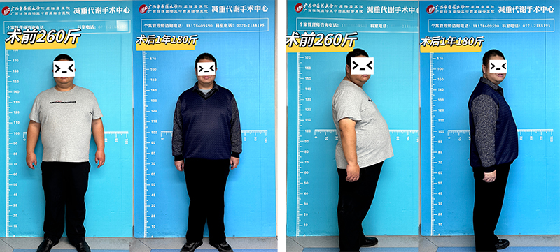 3患者术前及术后1年对比.jpg 3患者术前及术后1年对比.jpg